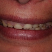 Aspecto extraoral: “envejecimiento de la sonrisa” por la erosión dental sufrida