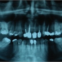 Paciente de 43 años que acude a la consulta por dolor e inflamación de la encía de los dientes anterosuperiores. En la radiografía se observa imagen compatible con quiste odontogénico