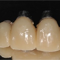Aspecto de la prótesis provisional sobre los implantes para el remodelado gingival tras ser removida para su modificación en clínica… 