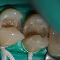 Detalle de dos premolares tras la eliminación de la caries.