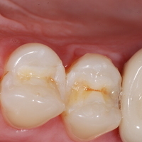 Revisión  a los 12 meses de la cementación mediante adhesión. Este método permite respetar la máxima estructura dentaría  sana, eliminando únicamente el tejido afectado por la caries.